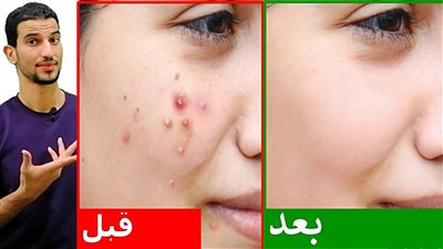 تخلص من حب الشباب واثارها عن طريق مكعبات الثلج