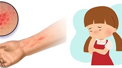 ماهي طرق علاج الاكزيما بالكركم 